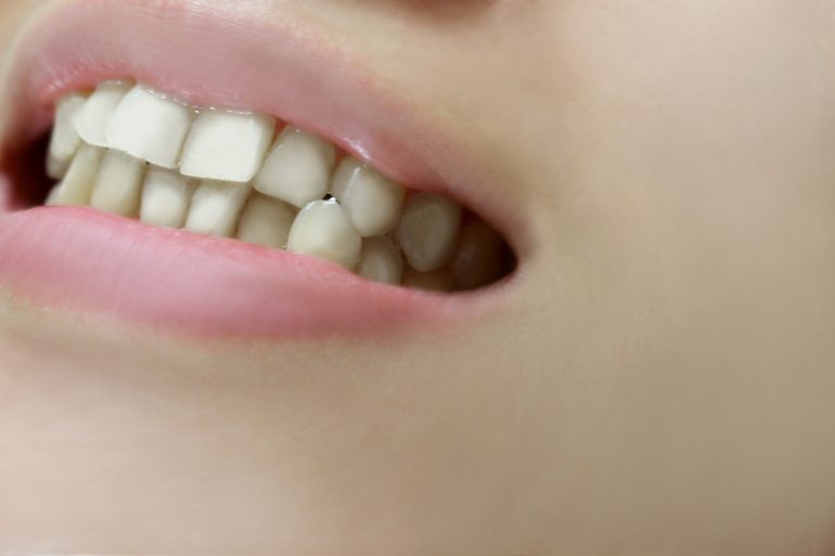 歯本来の白さが取り戻せるほか、病気予防・口臭予防などの効果も